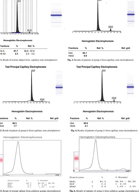 Figure 1 From Quantitative Determination Of Hba2 Level In β Thalassemia Trait By Using Capillary