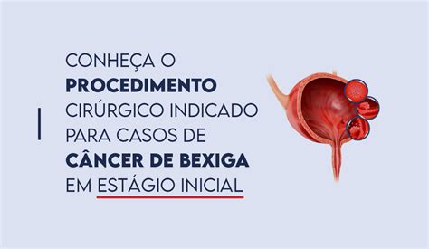 Dr Pedro Romanelli Urologista Bh Conhe A O Procedimento