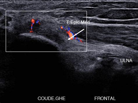 Comment Et Pourquoi Analyser Avec Pr Cision Les Tendons Picondyliens