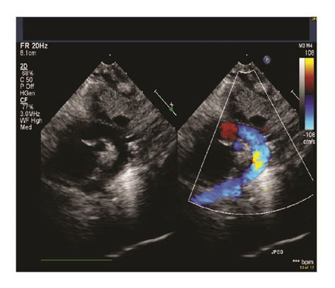 Echocardiogram Suprasternal View Demonstrating A Normal Aortic Arch