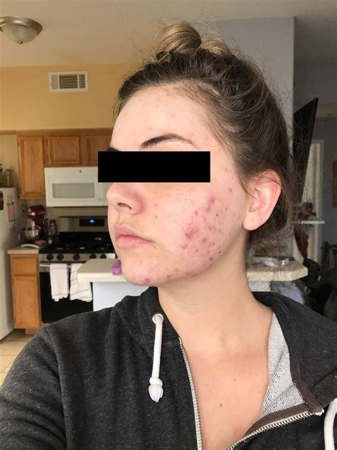 Cystic Acne Hormonal Reddit Shearlingwomenbestquality