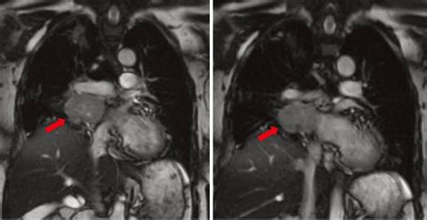 Paraganglioma Tumor Causes Symptoms Diagnosis Treatment