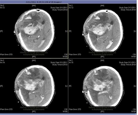 The Hong Kong Minimally Invasive Brain And Spine Neurosurgery Centre Stroke In Depth