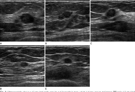 Figure 2 From Synchronous Encapsulated Papillary Carcinoma And Invasive Ductal Carcinoma Arising