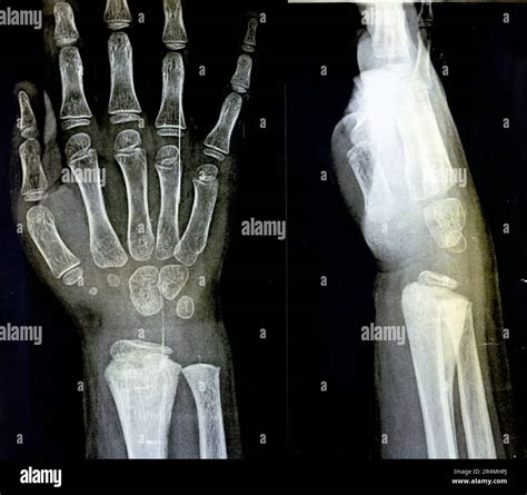 Wrist Injury X Ray At Ricardo Lafayette Blog