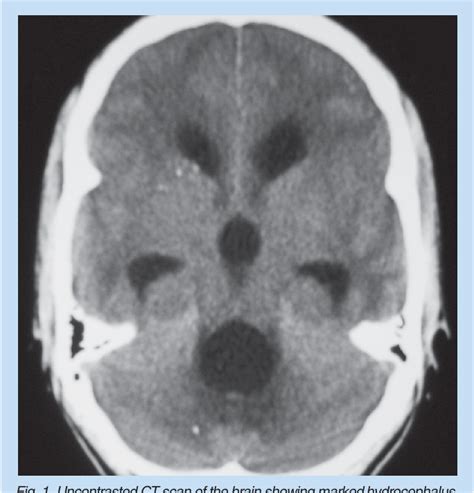 Figure 1 From Migrating Intraventricular Neurocysticercus Cyst Semantic Scholar