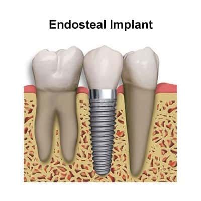 The customer's guide to water flossers - DentalDost