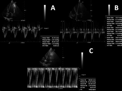 Rapid Ultrasound In Shock Rush Velocitytime Integral Blanco