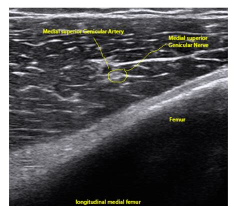 Figure 1 From Ultrasound Guided Genicular Nerve Block A Motor Sparing Technique For The