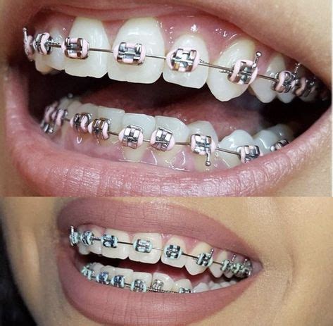 7 Rainbow braces ideas | braces, cute braces, braces colors