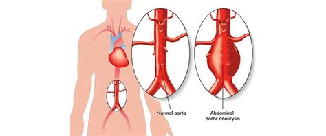 Endo vascular Repair of Abdominal Aortic Aneurysm is Safe