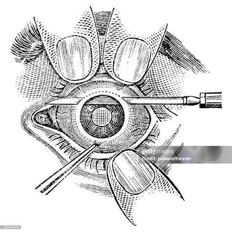 Medical Illustration Of Albrecht Von Graefes Modified Linear Extraction