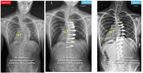 Before And After Scoliosis Surgery With Darryl Antonacci