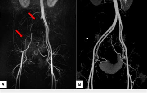 Time Resolved Contrast Enhanced Magnetic Resonance Angiography Mra Download Scientific