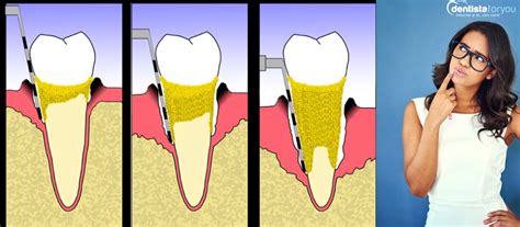 Come Si Formano Le Tasche Gengivali Sintomi Cause Rimedi E Cure