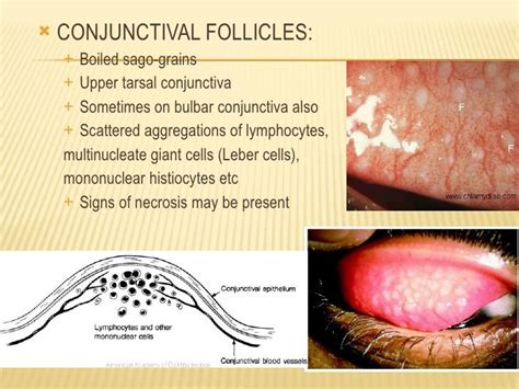 inflamed papillae - pictures, photos