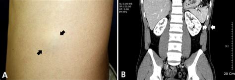 A Solitary Skin Colored Subcutaneous Mass On The Left Flank Black