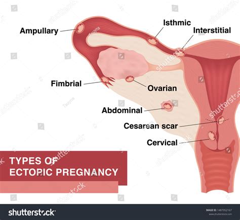 Types Ectopic Pregnancy Vector Realistic Medical Vector στοκ χωρίς