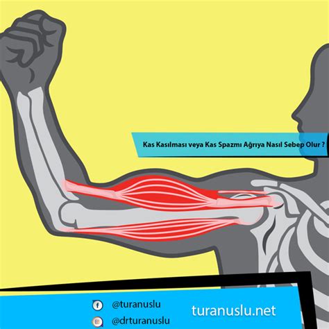 Kas Kasılması veya Kas Spazmı Ağrıya Nasıl Sebep Olur 2025