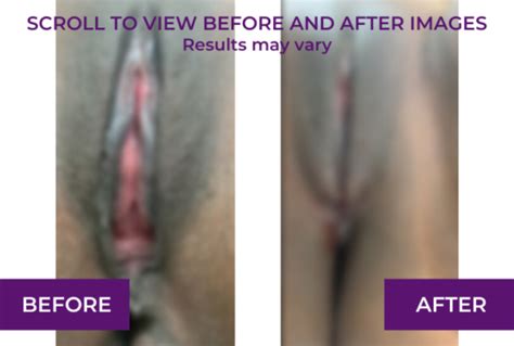 Perineoplasty Before And After Images And Videos Dr Michael Tahery