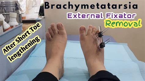 Brachymetatarsia: External Fixator Removal || After short toe ...