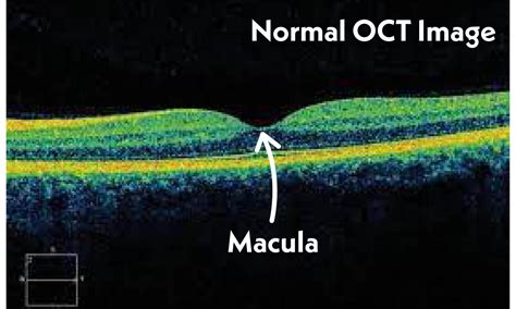 What Does An OCT Photo Capture And Why Is It Necessary Tennessee Retina