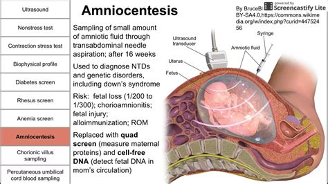 Prenatal Diagnostic Testing Hiccups Pregnancy