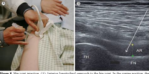 Figure 1 From Ultrasound Guided Intra Articular Injections Semantic Scholar