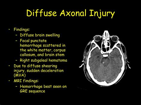 Ppt Anoxic Brain Injury Powerpoint Presentation Free Download Id 9709070