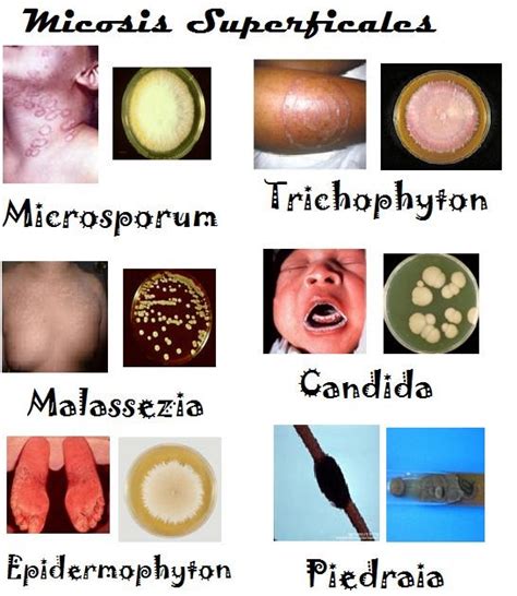 Micología Extrema Micosis Superficiales