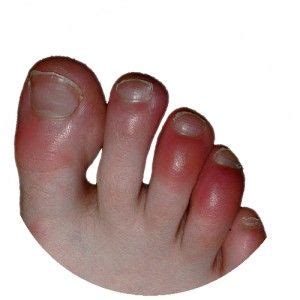 Red Toes Symptoms