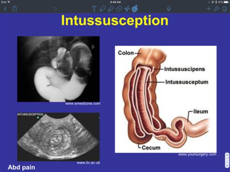 Physiology Bowel Intestinal Obstruction Flashcards Quizlet