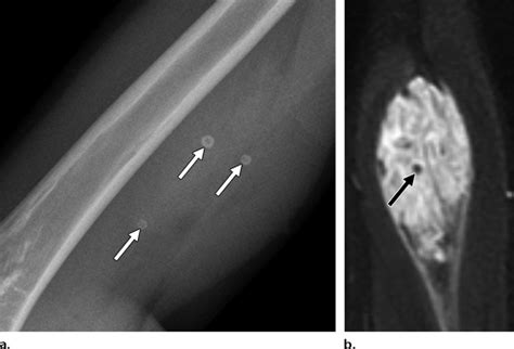 Venous Malformation In A 9 Year Old Girl With A Compressible Upper Arm