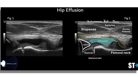 Anterior Hip Joint Ultrasound