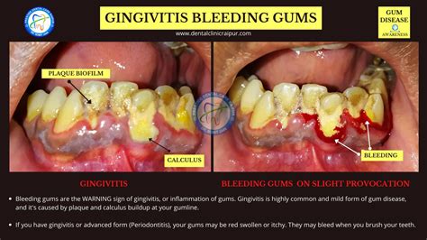 Periodontitis And Gingivitis Meaning Symptoms Tx Gum Disease