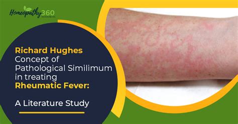 Erythema Marginatum Rheumatic Fever