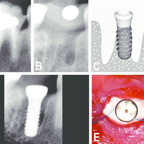 Pdf Immediate Implant Placement In Fresh Mandibular Molar Extraction