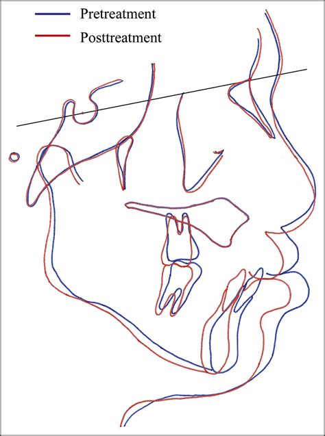 Interdisciplinary Treatment Of An Adult With Complete Bilateral Cleft Lip And Palate American