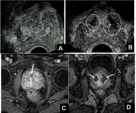 Ultrassonografia E Imagens Axiais De Rm Prost Tica De Um Mesmo