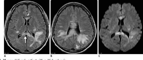 Figure 3 from Splenial Lesions of the Corpus Callosum: Disease Spectrum ...