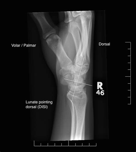 Hands Arthritis Oxford Orthopaedics