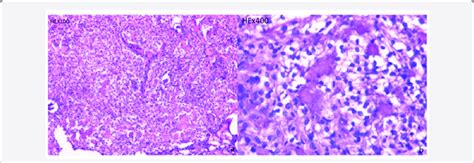 Pathological Features Of Spinal Clear Cell Meningioma Tumor Cells In Download Scientific