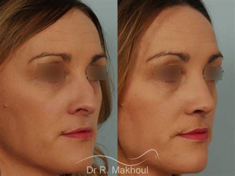 Rhinoplastie avant après photos et exemples de nez refaits