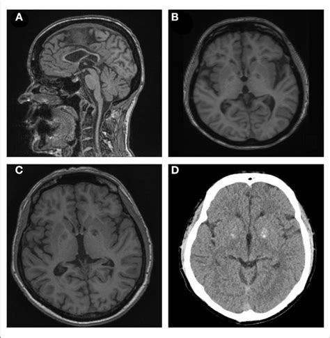 A B Sagittal T Weighted Brain Magnetic Resonance Imaging Mri Of