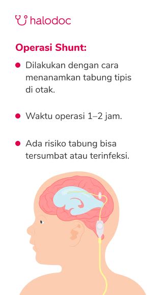 Ketahui Metode Operasi Untuk Menangani Hidrosefalus