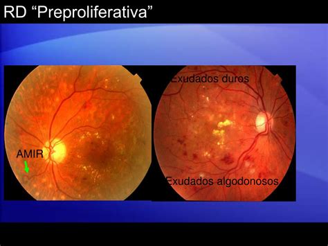 PPT RETINOPATÍA DIABÉTICA PowerPoint Presentation free download ID