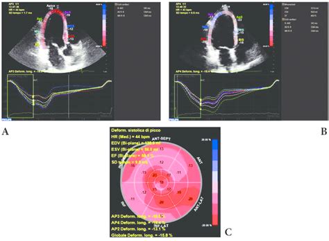 Global Longitudinal Strain Calculation On Top Showing Tracking In