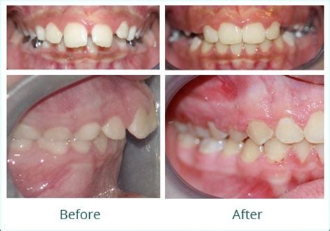 Overjet Treatments James Waters Orthodontics Austin Tx