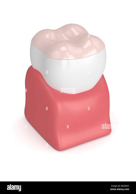 D Render Of Tooth With Dental Onlay Filling In Gums Isolated Over