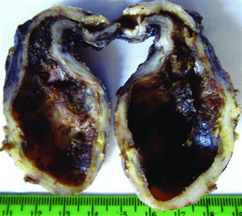 Primary Signet Ring Cell Carcinoma Of Gallbladder Grossly Diffuse Wall